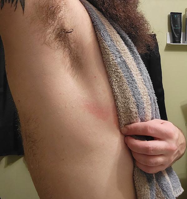 Help: Irritated Skin